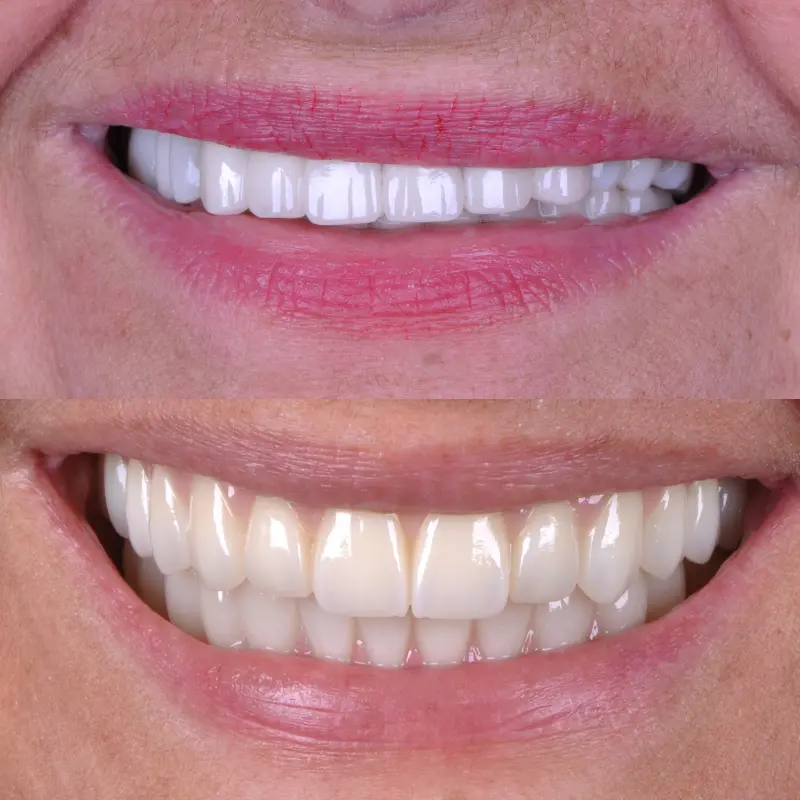 Tratamento com implantes dentários na Clínica Vitalitty
