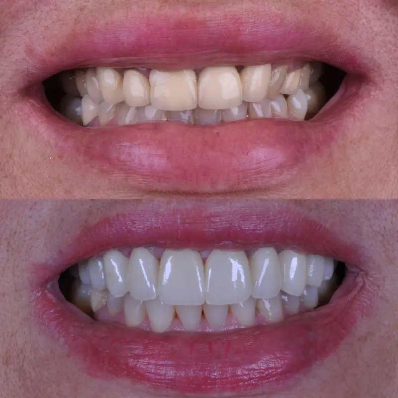 Tratamento com implantes dentários na Clínica Vitalitty