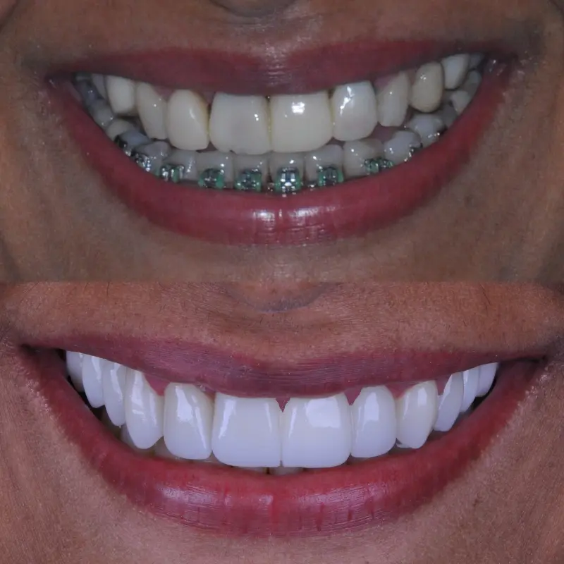 Tratamento com implantes dentários na Clínica Vitalitty
