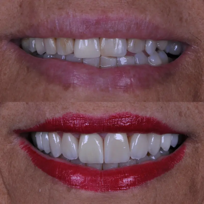 Tratamento com implantes dentários na Clínica Vitalitty